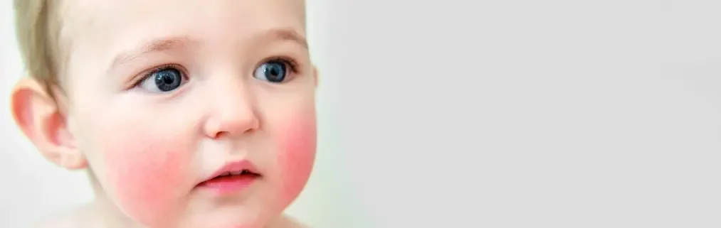 Çocuk Alerji Deri Testleri