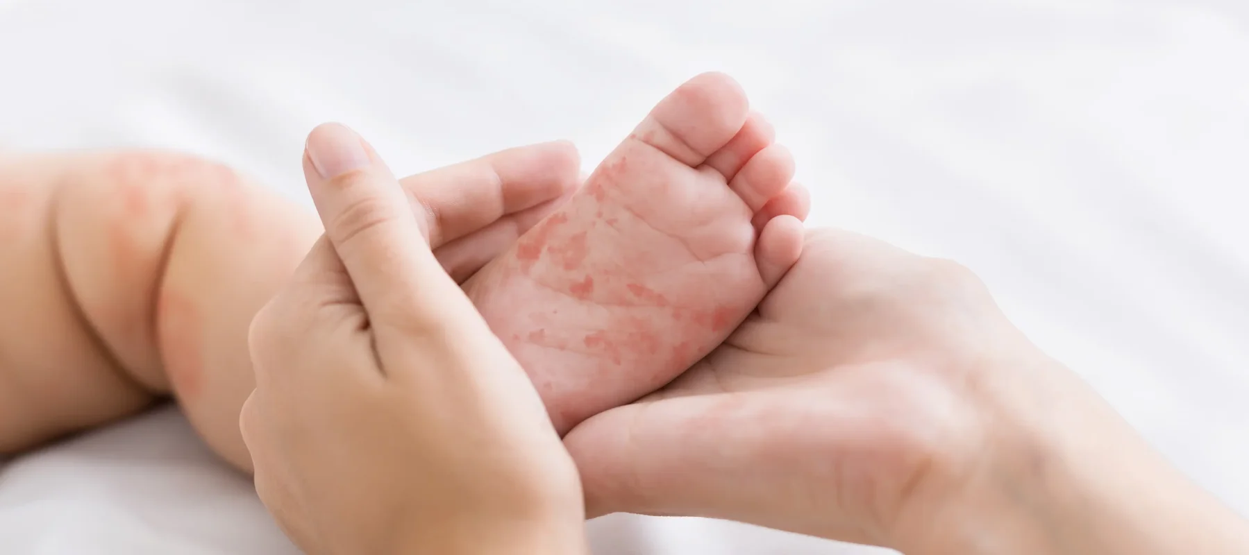 Alerjik Çocuk Tanı ve Tedavisi