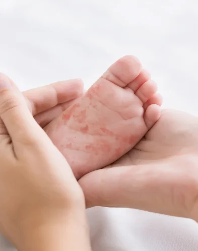 Alerjik Çocuk Tanı ve Tedavisi